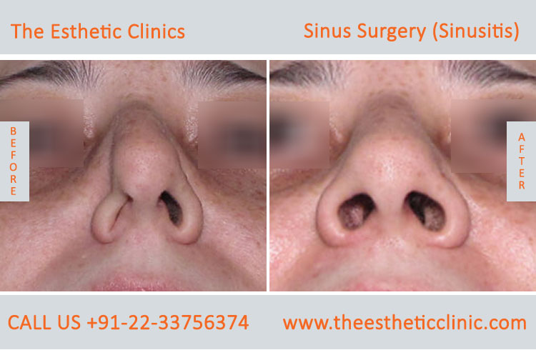 Sinus Surgery, Sinusitis before after photos in mumbai india (2)